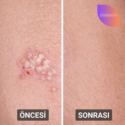 DERMAVA